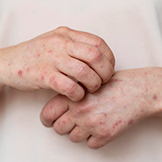 Allergy